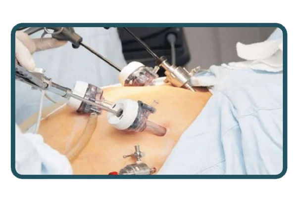 Laparoscopic Surgery